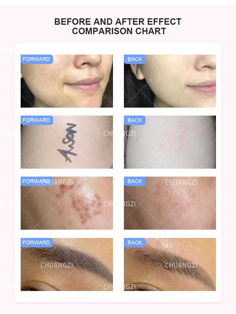 3in1 Ipl Laser Professional hair removal Machines OPT Pico nd yag Q-Switch Laser epilator Spot wrinkle remove red blood Machine